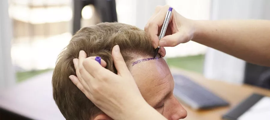 vücut kılı saç ekimi